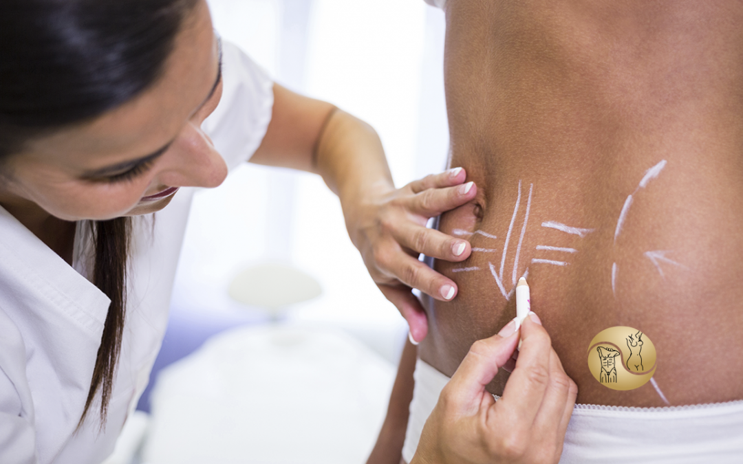 Lipoaspiração: Mitos e verdade