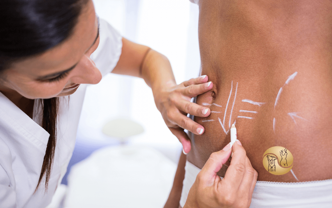 Lipoaspiração e abdominoplastia, qual a diferença?