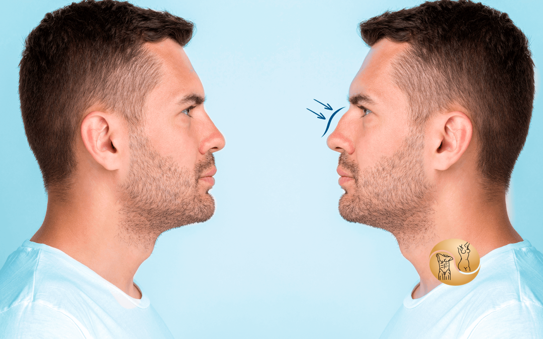Rinoplastia masculina: tudo que você precisa saber