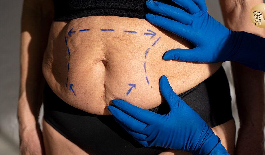 Conheça as principais diferenças entre Lipo Convencional e Lipo HD