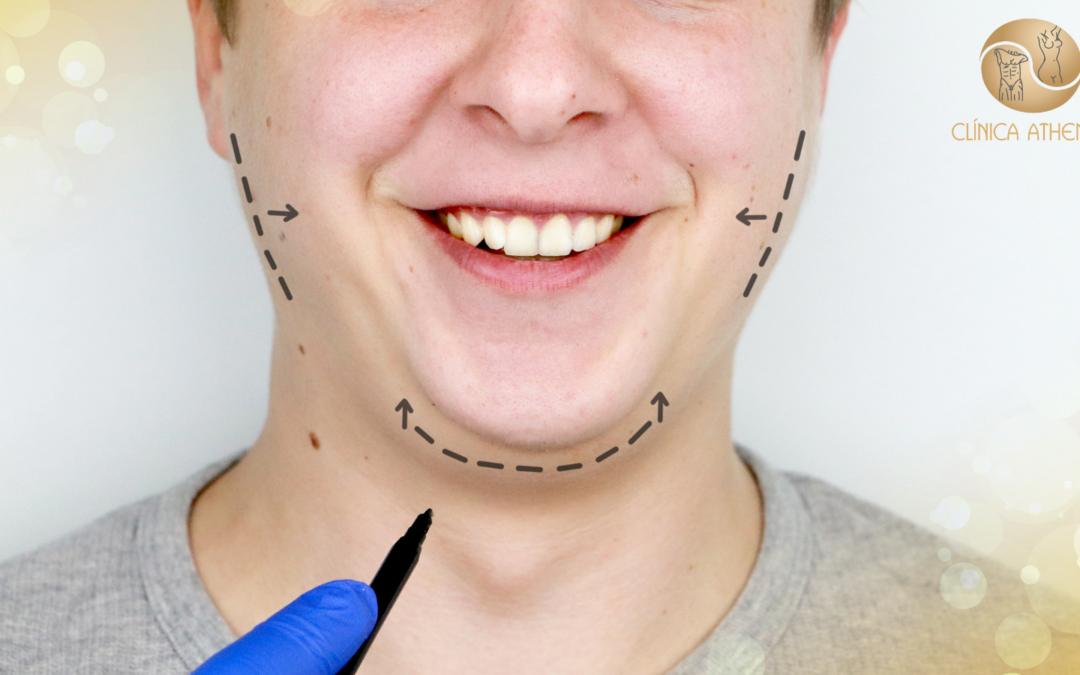 MENTOPLASTIA: A CIRURGIA PLÁSTICA QUE TRANSFORMA E REDEFINE O CONTORNO DO QUEIXO